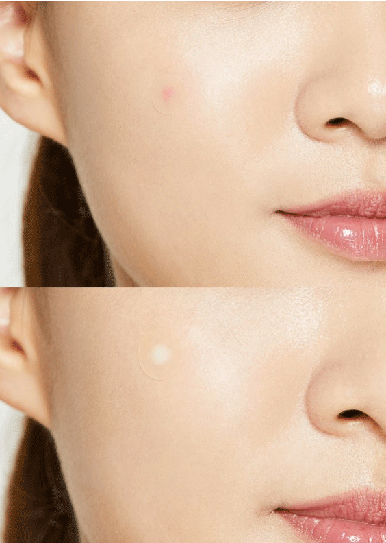 COSRX-Acne-PImple-Master-Patch-Before-and-After skincare-kbeauty-glowtime-COSRX Acne Pimple Master Patch
