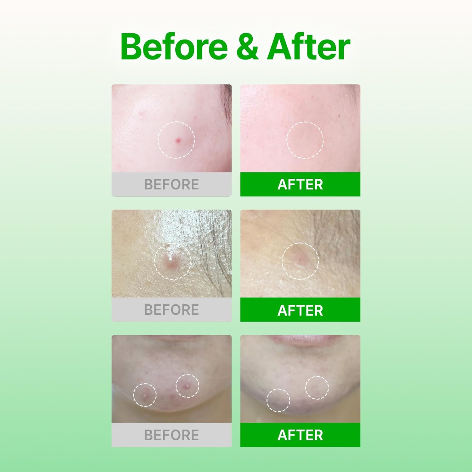 ACROPASS Trouble Care Microcone patch 5 skincare-kbeauty-glowtime-acropass trouble care microcone patch