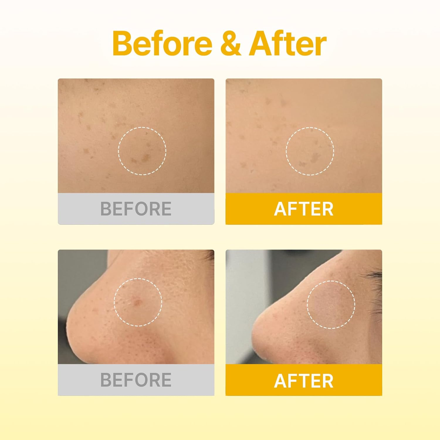 ACROPASS Dark spot care microcone patch 6