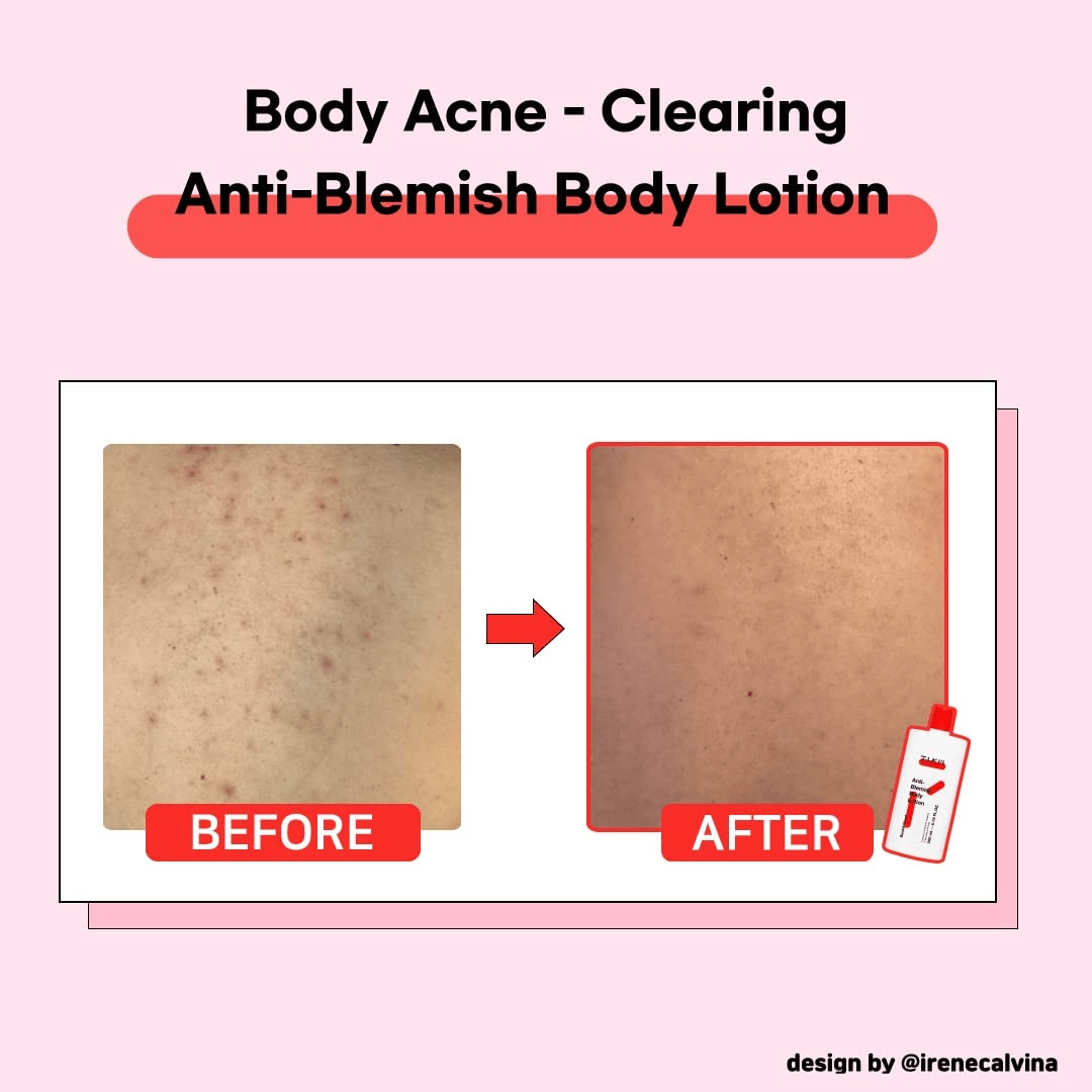 TIAM Anti Blemish Body Lotion 4 skincare-kbeauty-glowtime-tiam anti blemish body lotion