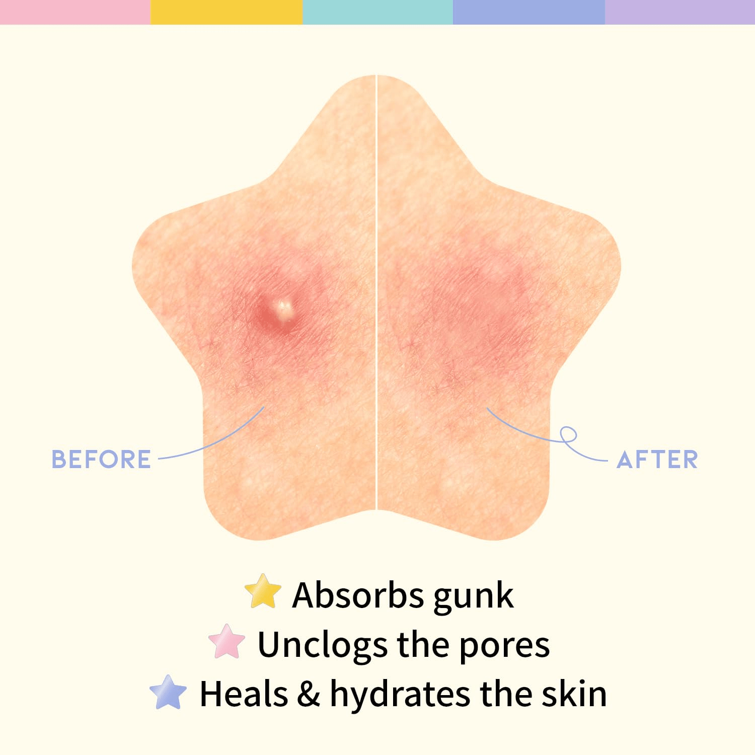 OOTD Star Spot Patches 5 skincare-kbeauty-glowtime-ootd star spot patches