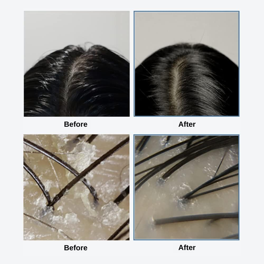 GROWUS Sea Salt Therapy Scalp Scaler 6 skincare-kbeauty-glowtime-growus sea salt therapy scalp scaler