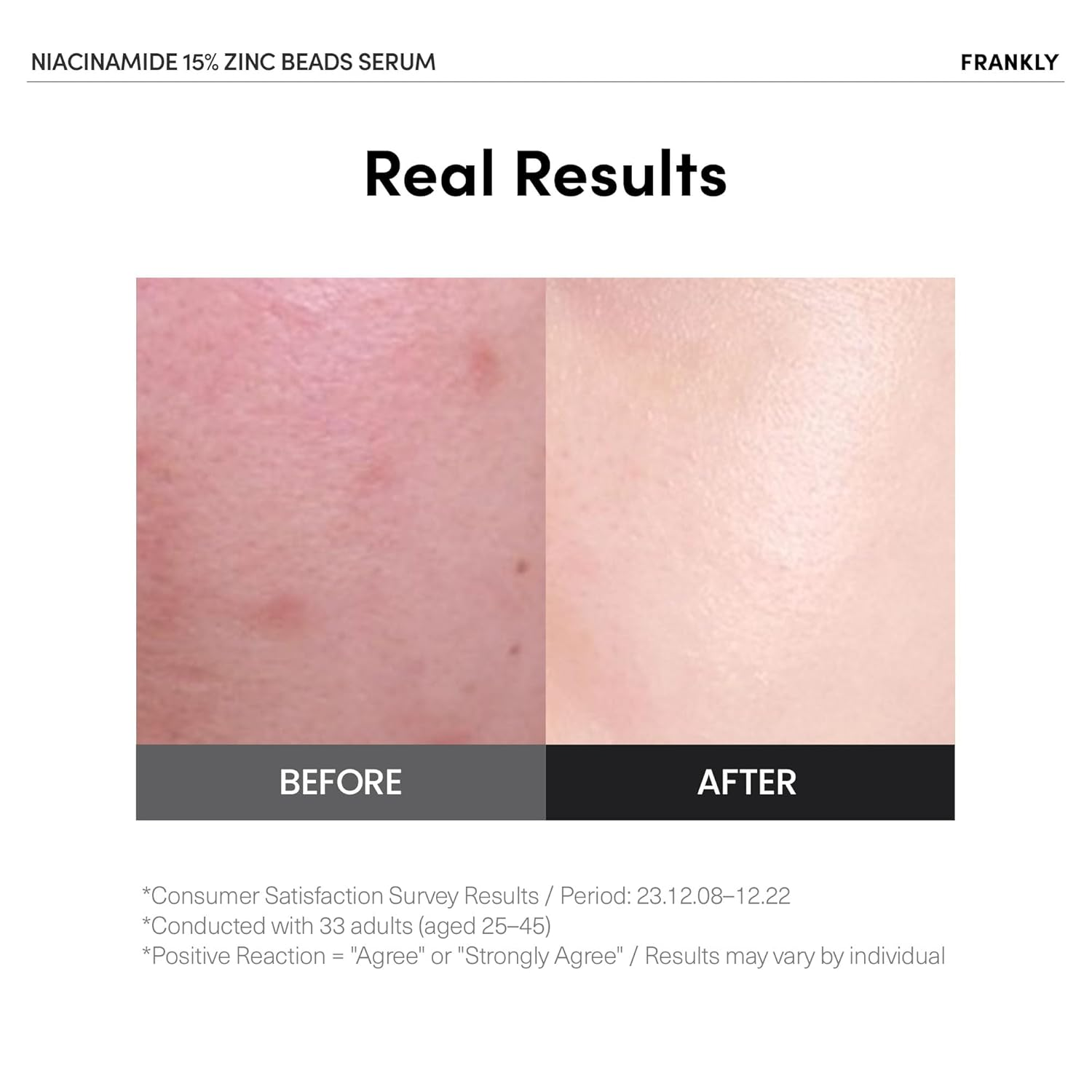 FRANKLY Niacinamide and Zinc Beads Serum 2 skincare-kbeauty-glowtime-frankly niacinamide and zinc beads serum